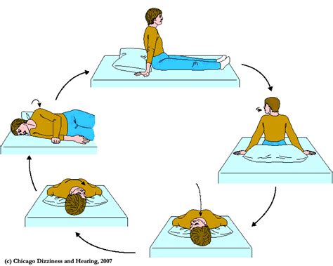 Epley-CRP maneuver for BPPV