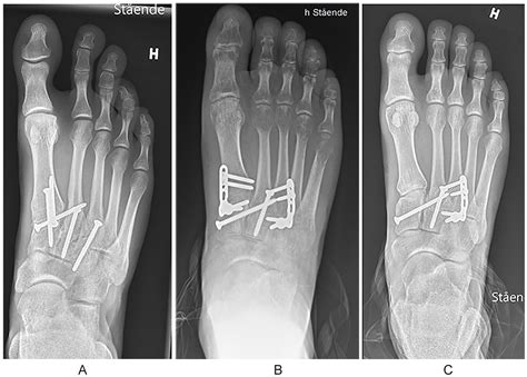 Temporary Bridge Plating vs Primary Arthrodesis of the First ...