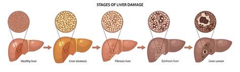 What are the 5 stages of liver disease? - Causes of Liver Disease