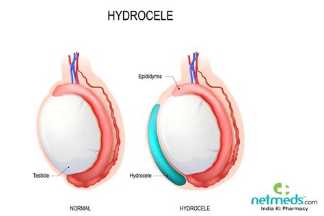 Hydrocele: Causes, Symptoms And Treatment