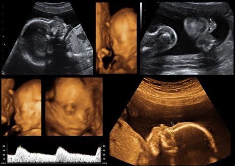 Understanding 2D, 3D and 4D pregnancy ultrasounds - International ...