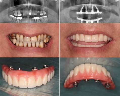 If you wear a denture and you are unsatisfied with it, your chewing ...