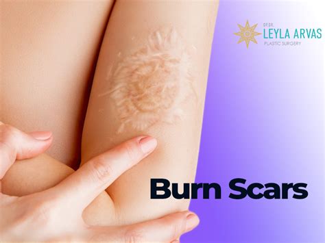 Burn Scars - Expert Advice and Treatment Options - 2024