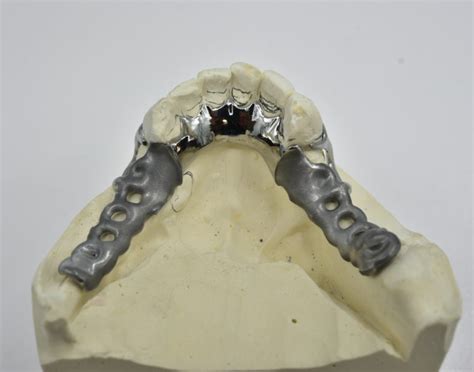 Metal Partials - Peterson Dental Laboratory