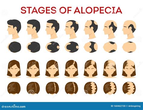 Alopecia Stages Set. Hair Loss, Balding Process. Male Vector ...