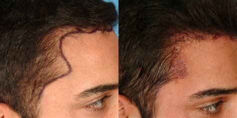 How Long Does the FUE Procedure Take? | Hair Transplant Dubai