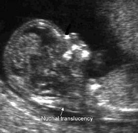 Nuchal Translucency Scan (NTS) in Pregnancy | Obstetric Excellence