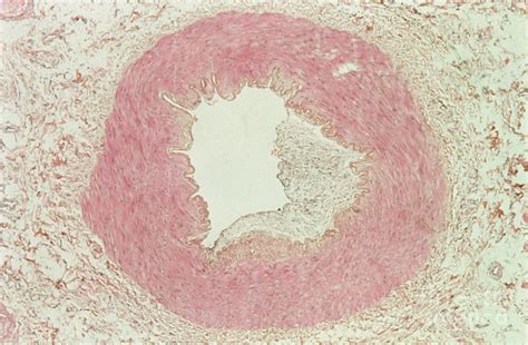 Lm Of A Section Through Atheroma In An Artery Photograph by Biophoto ...