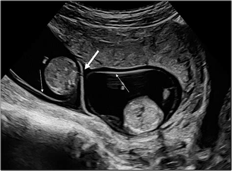 Monochorionic Diamniotic Twins Ultrasound