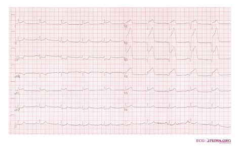 Anterior myocardial infarction - wikidoc