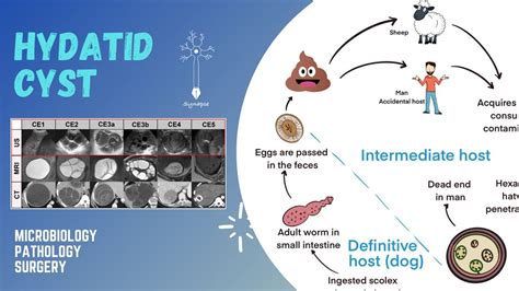 Hydatid cyst - YouTube