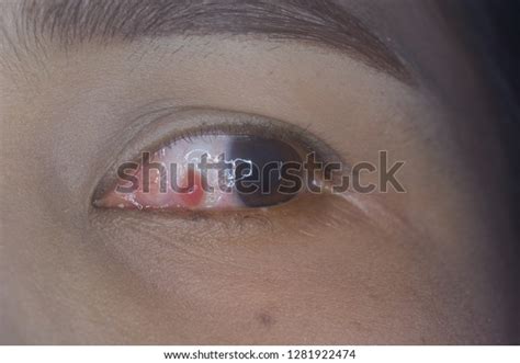 Close Pyogenic Granuloma During Eye Examination Stock Photo 1281922474 ...