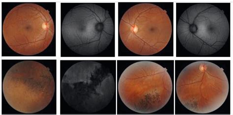 Azoor: Acute Zonal Occute Outer retinopathy associated with autoimmune ...