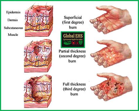 Electrical Burns First Aid