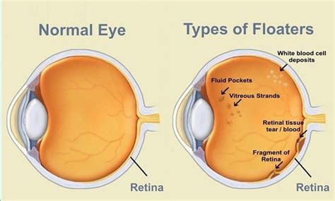 A Comprehensive Guide to Floaters | Laser Eye Surgery Hub