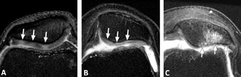 Chondromalacia patellae grades II–IV in various patients. (A) Axial ...