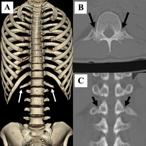 The association between lumbar rib and lumbosacral transitional ...