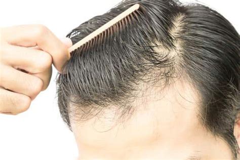 25 Ways to Prevent Hair Loss for Men | Man Matters