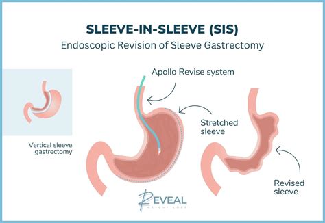 Gastric Sleeve Revision In Livingston, NJ - SIS Procedure