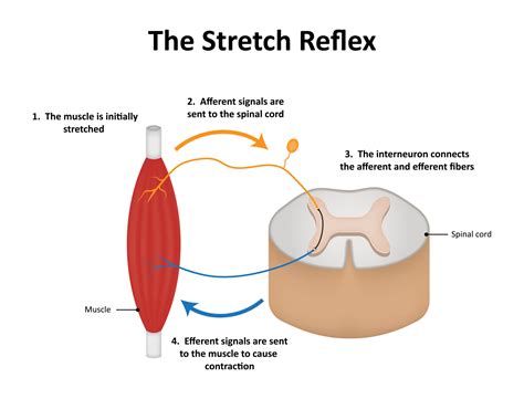 Spasticity and Stroke