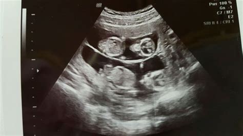 Fraternal twin ultrasound | Twins ultrasound, Baby ultrasound, Ultrasound