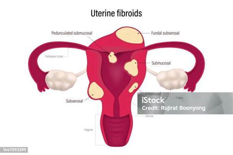 Lokasi Fibroid Rahim Submukosa Pedunculated Subserosal Fundal Submukosa ...