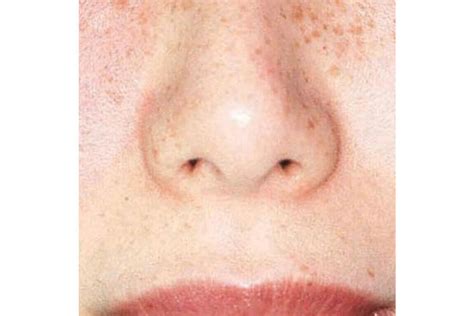 Laser Treatment for Hyperpigmentation | Javivo Clinic