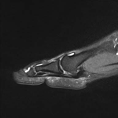 Radiology Cases: Plantar Plate Tear