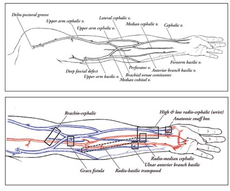 Cannulate No Fistula Before It’s Time: AVF Maturation 101 - Renal ...