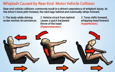 symptoms of whiplash from rear-end collision - Taunya Whittaker