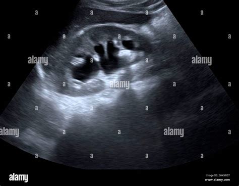 Kidney Stone Ultrasound