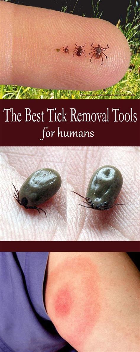 tick removal tools for humans aren't the same ones that are for dogs ...