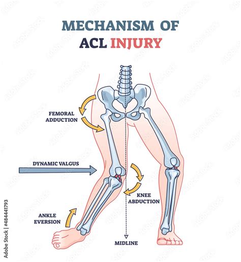 Mechanism of ACL injury as knee trauma anatomical explanation outline ...