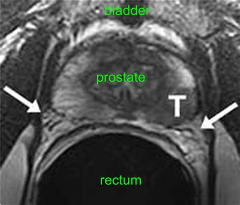 Prostate MRI Scan