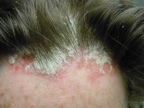 What does scalp psoriasis look like | Symptoms and pictures