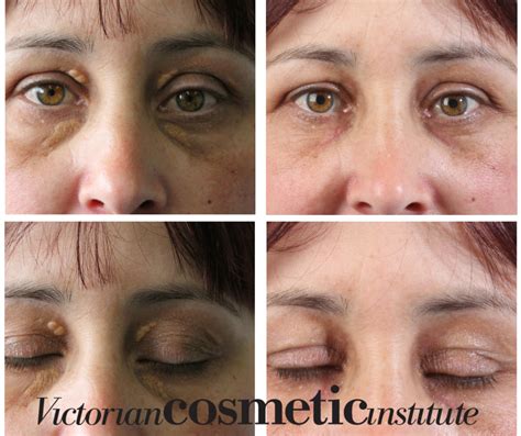 Xanthelasma - Victorian Cosmetic Institute