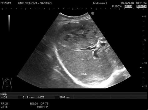 Hepatocellular carcinoma [2 images] – EFSUMB