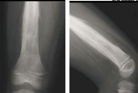 Ewing Sarcoma - Oncology - Medbullets Step 2/3