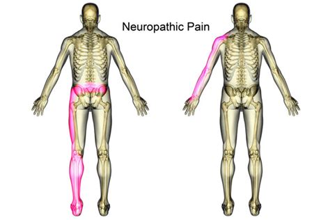 Neuropathic Pain Symptoms & Treatment - Psychiatry Advisor