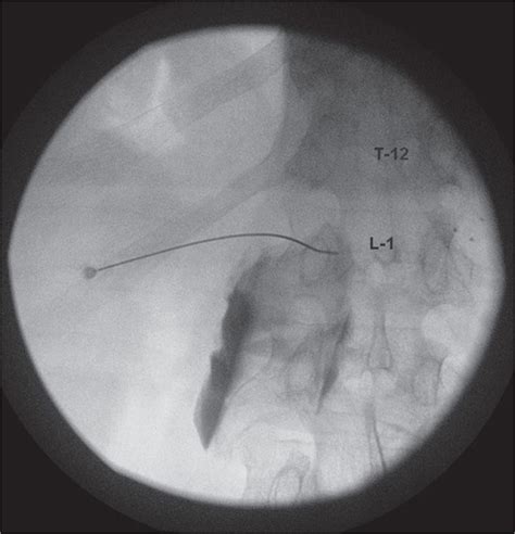 Celiac Plexus Block Using Fluoroscopic Guidance | Anesthesia Key