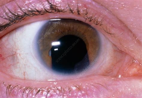 Close up of eye showing COLOBOMA - Stock Image - M155/0233 - Science ...