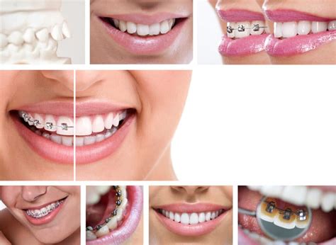 22631436 – dental braces – lingual braces, before and after | Soft ...