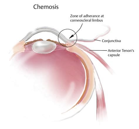 20 Chemosis: Clinical Overview | Ento Key