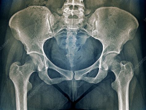 Female pelvis bones and joints, X-ray - Stock Image - C033/7355 ...