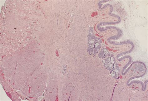 Pathology Outlines - Duplication cyst