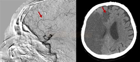 Complications of endovascular procedures | STROKE MANUAL