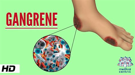 Gangrene - Types, Symptoms, And Treatments