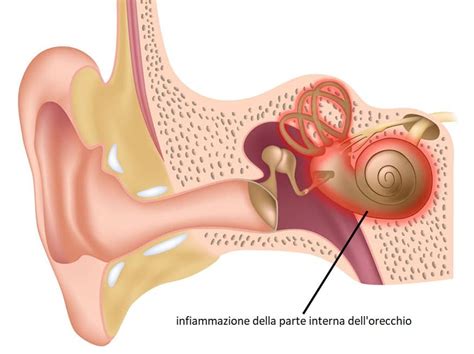 Come si cura la labirintite? - Centro Esculapio Lucca