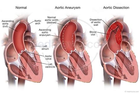 Aortic Aneurysm and Aortic Dissection | Aortic dissection, Aneurysm ...