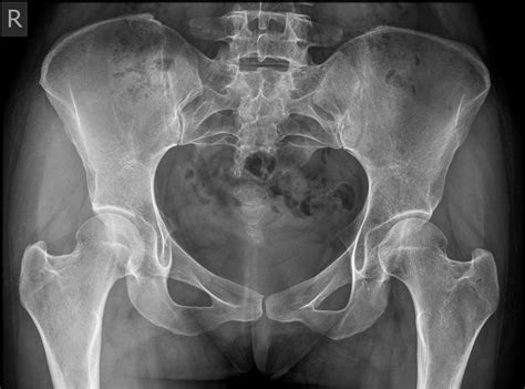 Sacrum Xray